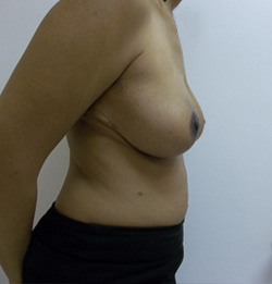 After Breast Lift