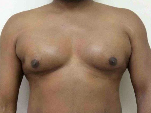 Before Male Breast Reduction